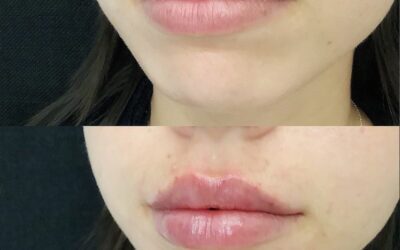 before and after results from filler treatment at 5th and Wellness in Boca Raton, FL