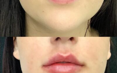 before and after results from filler treatment at 5th and Wellness in Boca Raton, FL