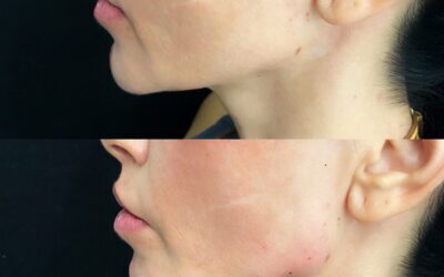 before and after results from filler treatment at 5th and Wellness in Boca Raton, FL