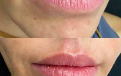 before and after results from filler treatment at 5th and Wellness in Boca Raton, FL