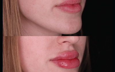 before and after results from filler treatment at 5th and Wellness in Boca Raton, FL