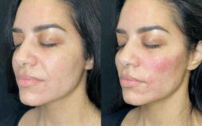 before and after results from filler treatment at 5th and Wellness in Boca Raton, FL