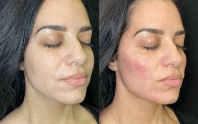 before and after results from filler treatment at 5th and Wellness in Boca Raton, FL