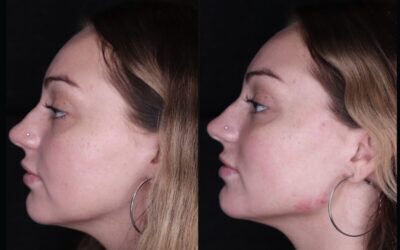 before and after results from filler treatment at 5th and Wellness in Boca Raton, FL