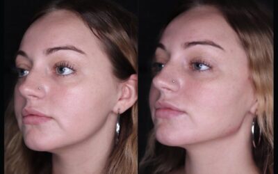 before and after results from filler treatment at 5th and Wellness in Boca Raton, FL