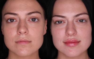 before and after results from filler treatment at 5th and Wellness in Boca Raton, FL