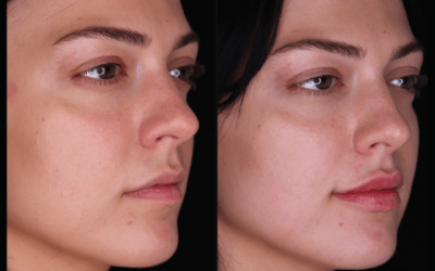 before and after results from filler treatment at 5th and Wellness in Boca Raton, FL