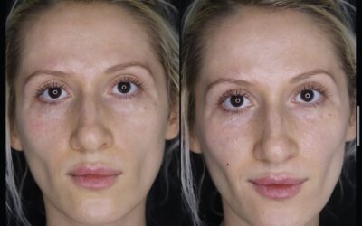 before and after results from filler treatment at 5th and Wellness in Boca Raton, FL