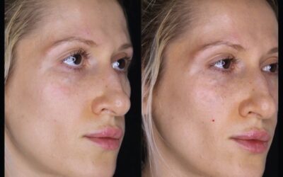 before and after results from filler treatment at 5th and Wellness in Boca Raton, FL