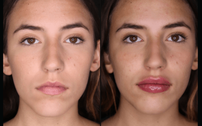 before and after results from filler treatment at 5th and Wellness in Boca Raton, FL