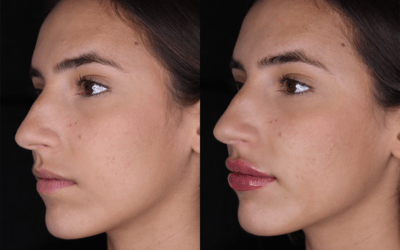 before and after results from filler treatment at 5th and Wellness in Boca Raton, FL