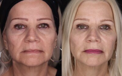 before and after results from filler treatment at 5th and Wellness in Boca Raton, FL