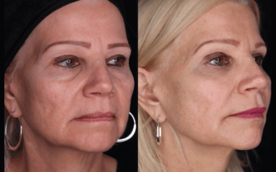 before and after results from filler treatment at 5th and Wellness in Boca Raton, FL