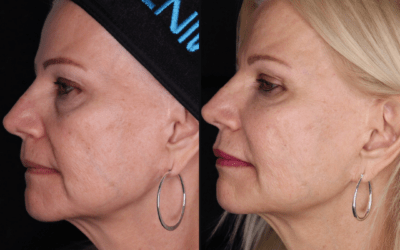 before and after results from filler treatment at 5th and Wellness in Boca Raton, FL