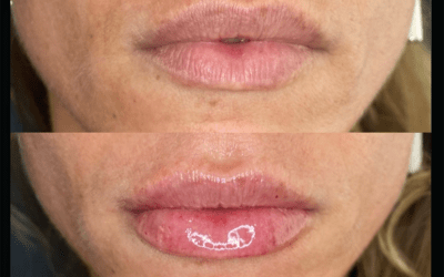 before and after results from filler treatment at 5th and Wellness in Boca Raton, FL