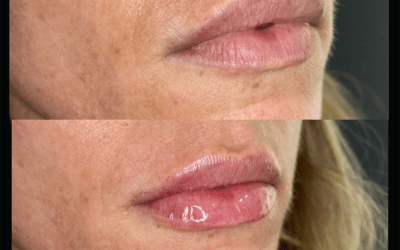 before and after results from filler treatment at 5th and Wellness in Boca Raton, FL