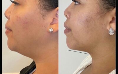 before and after results from Kybella treatment at 5th and Wellness in Boca Raton, FL