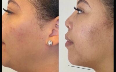 before and after results from Kybella treatment at 5th and Wellness in Boca Raton, FL