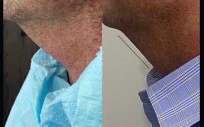 before and after results from Kybella treatment at 5th and Wellness in Boca Raton, FL