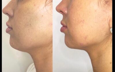 before and after results from Kybella treatment at 5th and Wellness in Boca Raton, FL