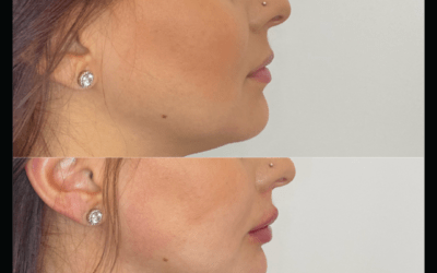 before and after results from Kybella treatment at 5th and Wellness in Boca Raton, FL