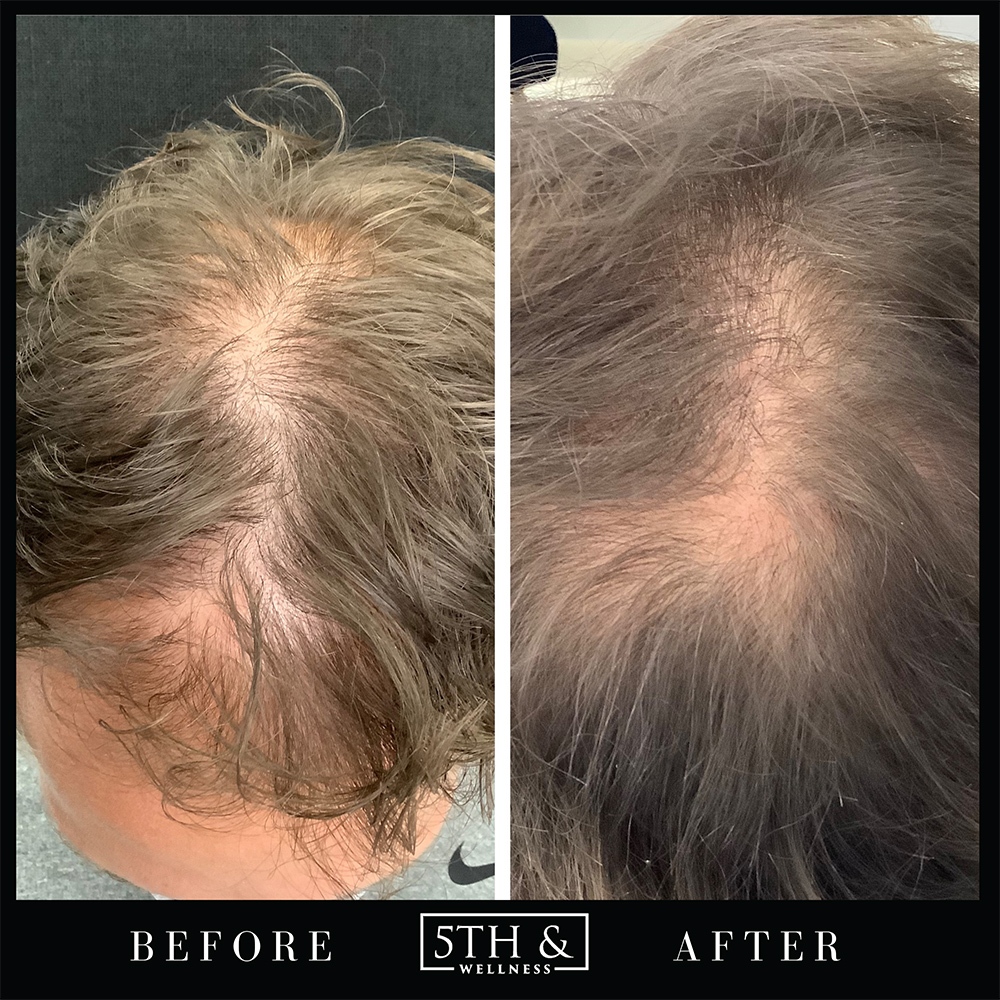 before and after results from PRP/PRF treatment at 5th and Wellness in Boca Raton, FL