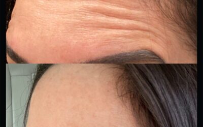 before and after results from tox treatment at 5th and Wellness in Boca Raton, FL