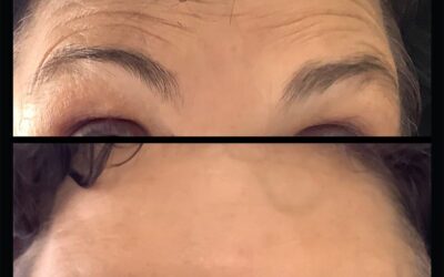 before and after results from tox treatment at 5th and Wellness in Boca Raton, FL