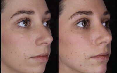 Filler Before and After Photo