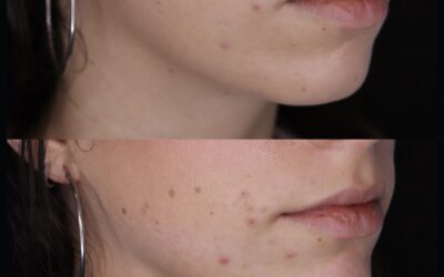 Filler Before and After Photo