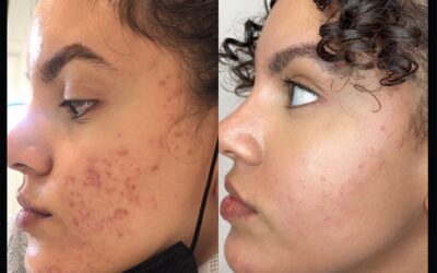 before and after results from skinpen microneedling treatment at 5th and Wellness in Boca Raton, FL