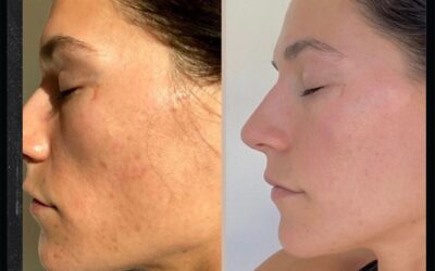 before and after results from skinpen microneedling treatment at 5th and Wellness in Boca Raton, FL