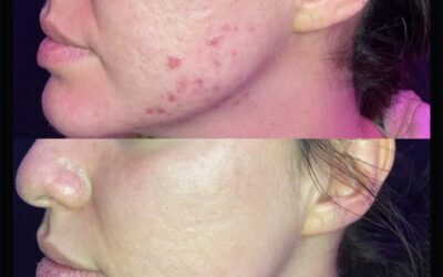 before and after results from skinpen microneedling treatment at 5th and Wellness in Boca Raton, FL