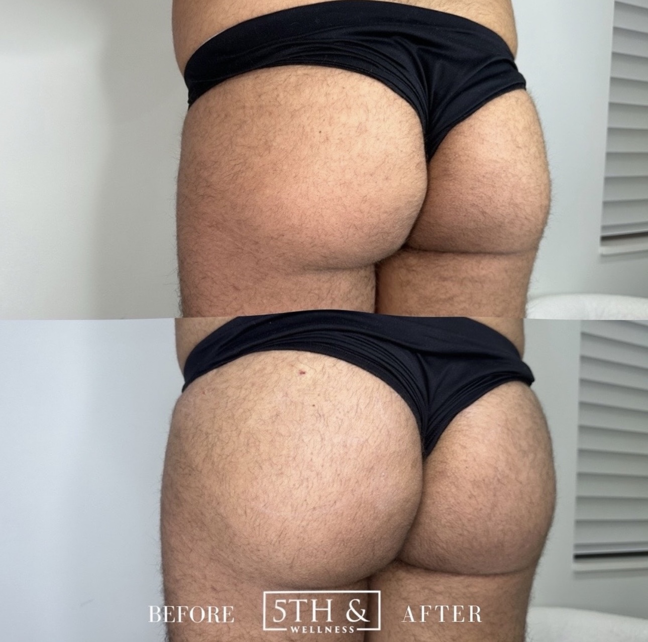 Liquid BBL Before and After Photo by 5th and Wellness in Boca Raton, FL