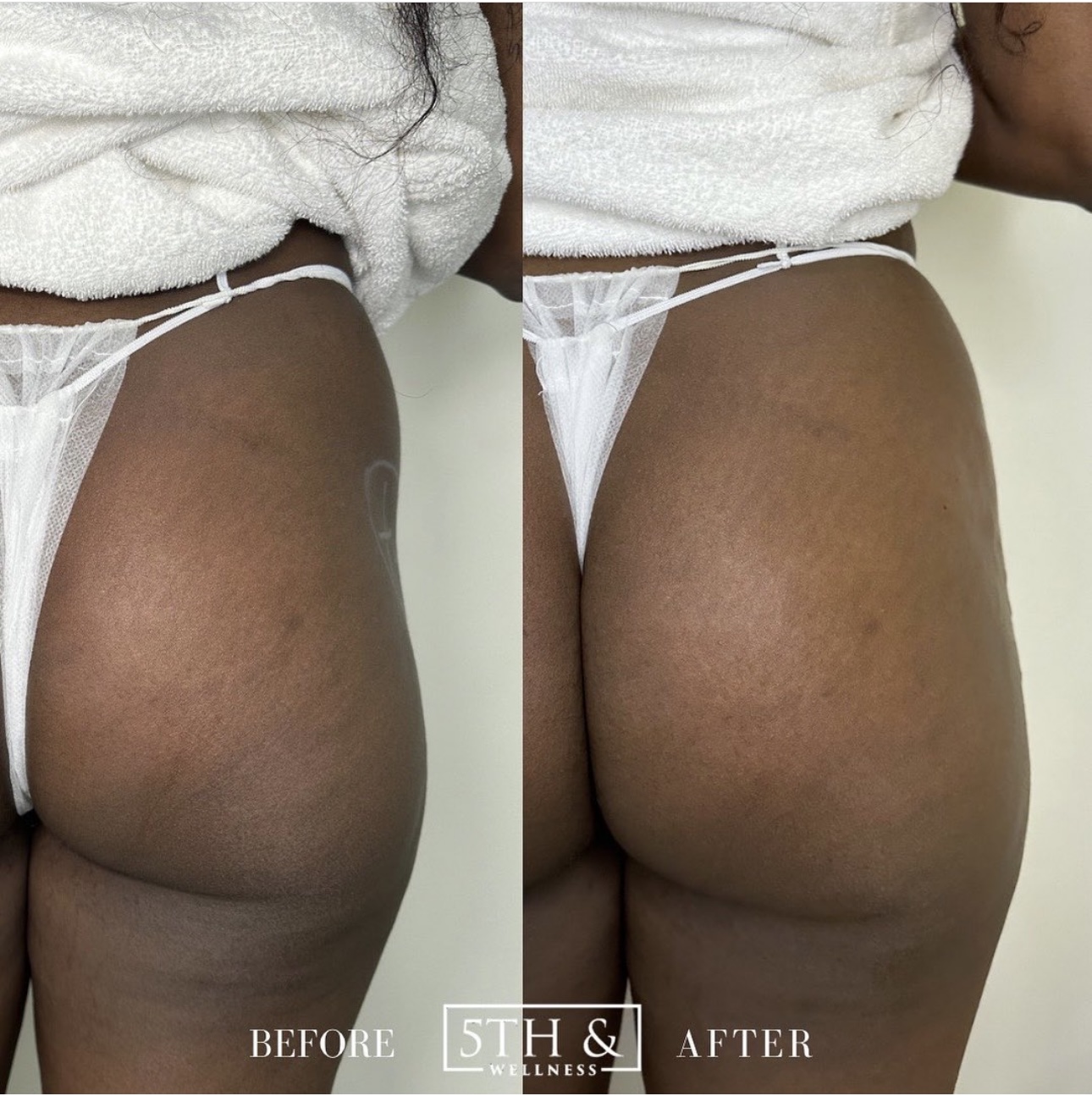 Liquid BBL Before and After Photo by 5th and Wellness in Boca Raton, FL