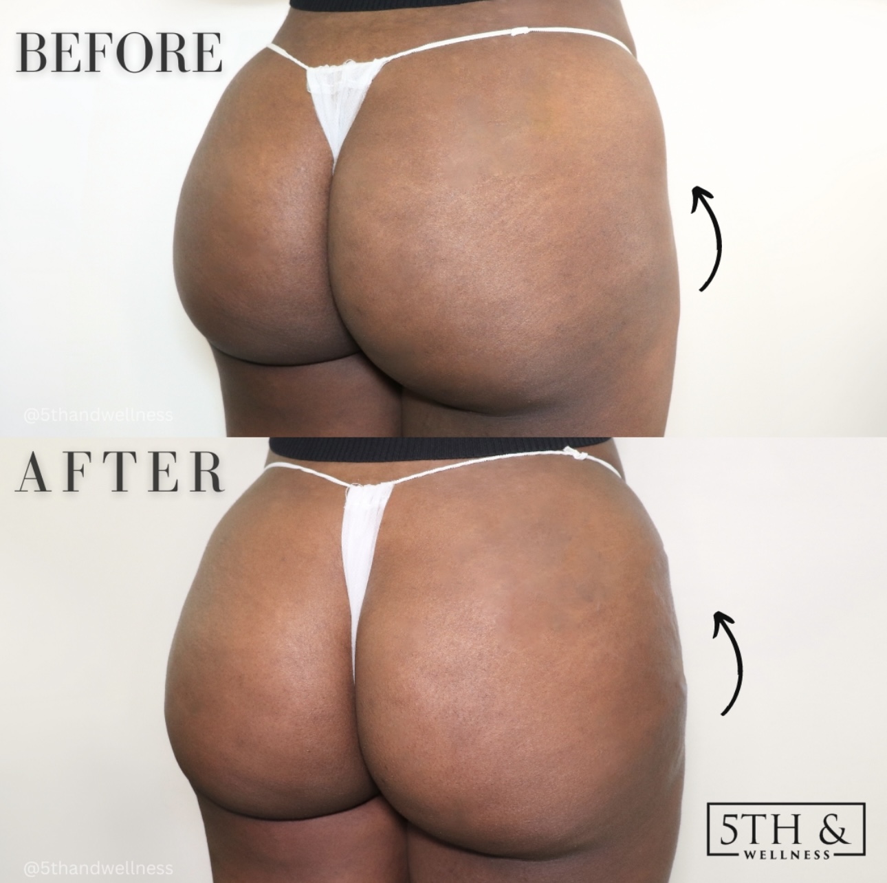 Liquid BBL Before and After Photo by 5th and Wellness in Boca Raton, FL